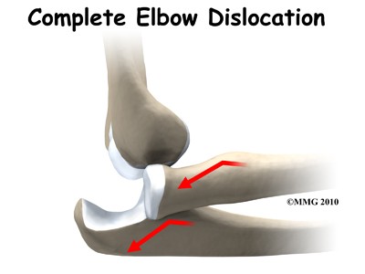 complete elbow dislocation
