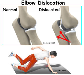 elbow dislocation