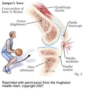 jumpers knee
