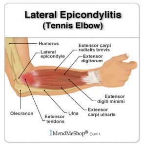 lateral epicondylitis