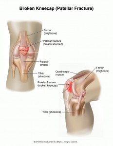 patellar fracture